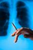 In Northern Ireland more than one in 10 cancers diagnosed are lung cancer, warns PHA 