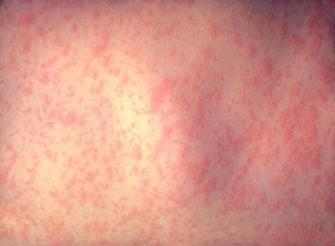 Public Health Agency declares measles outbreak