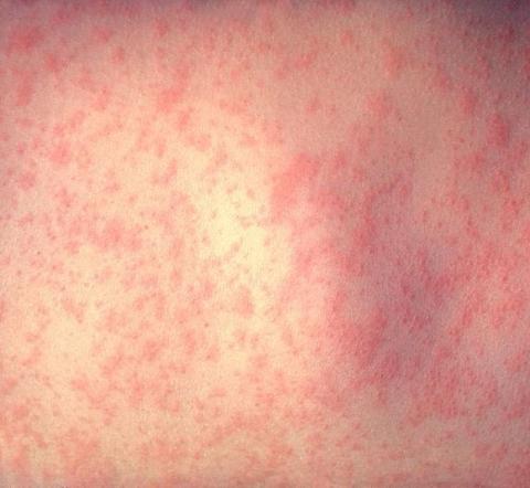Vaccine reminder after small number of measles cases confirmed