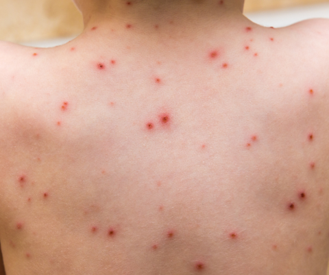 Chickenpox