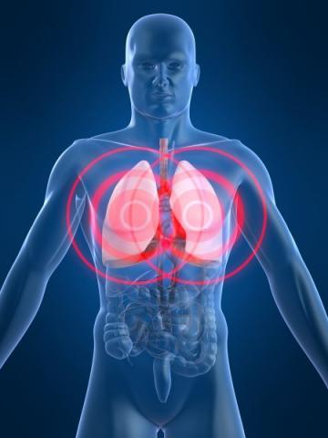 PHA Statement: Legionnaires' disease PHA Statement: Legionnaires' disease