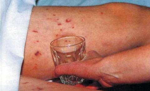 Students, do you know the signs of meningitis?