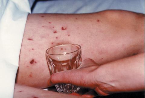 Meningococcal Infection - Downpatrick Meningococcal Infection - Downpatrick
