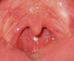 Smoking causes mouth cancer, PHA warns