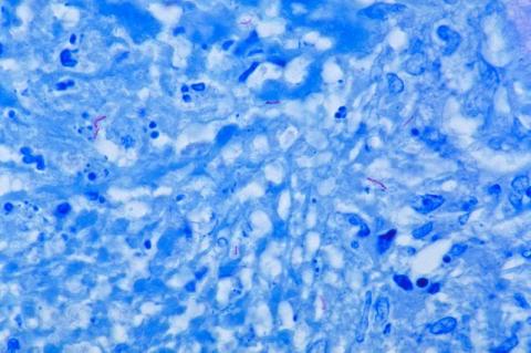 Tuberculosis (TB) on the rise in Northern Ireland Tuberculosis (TB) on the rise in Northern Ireland