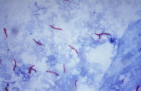 Tuberculosis still proving a threat in Northern Ireland Tuberculosis still proving a threat in Northern Ireland