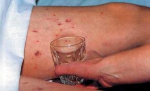 With PHA funding, Belfast’s meningitis diagnostic test moves closer to market With PHA funding, Belfast’s meningitis diagnostic test moves closer to market