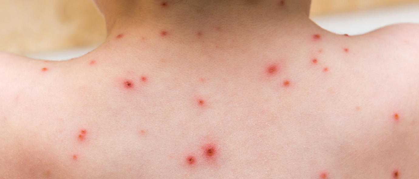 chickenpox